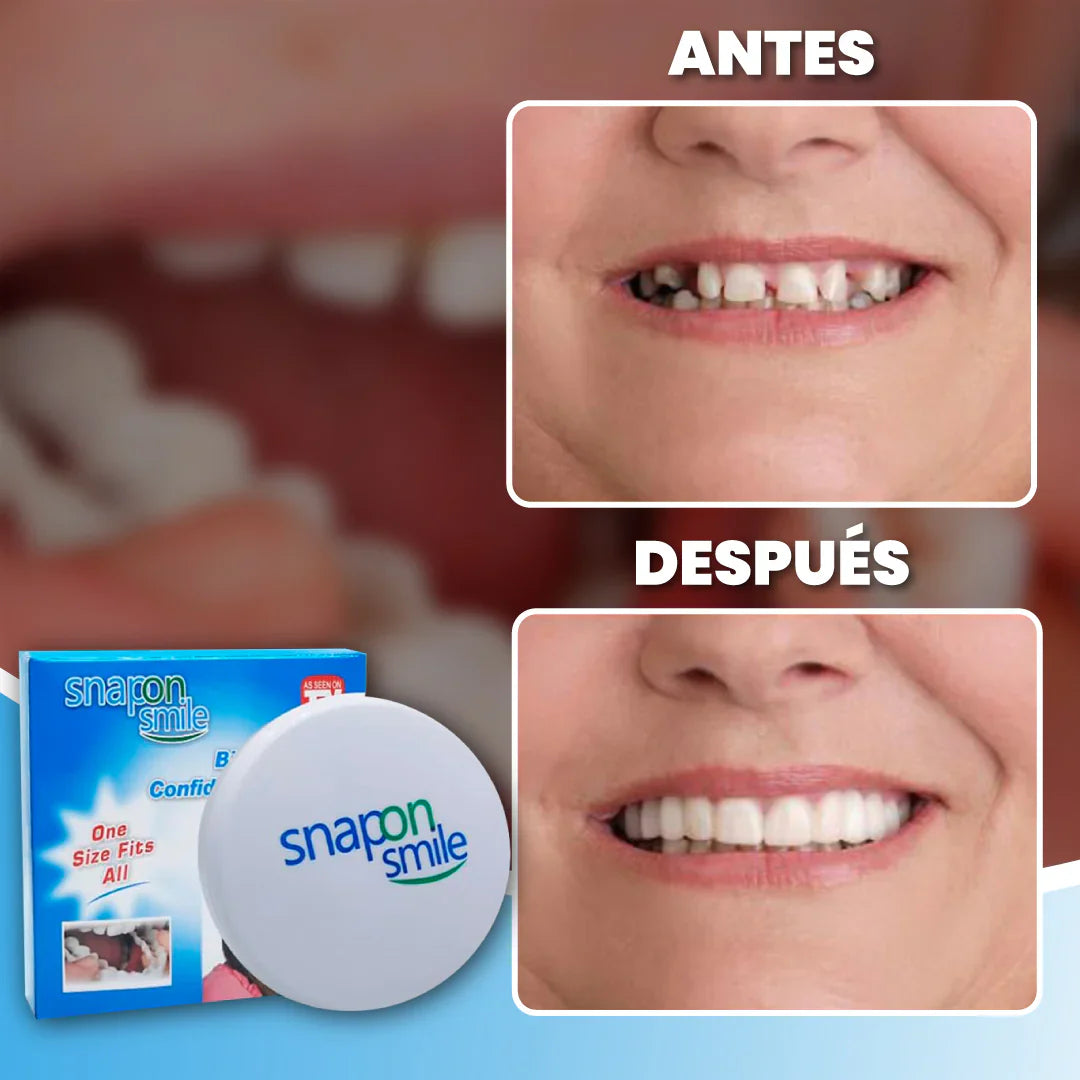 SnapSmile™ | Carillas Dentales